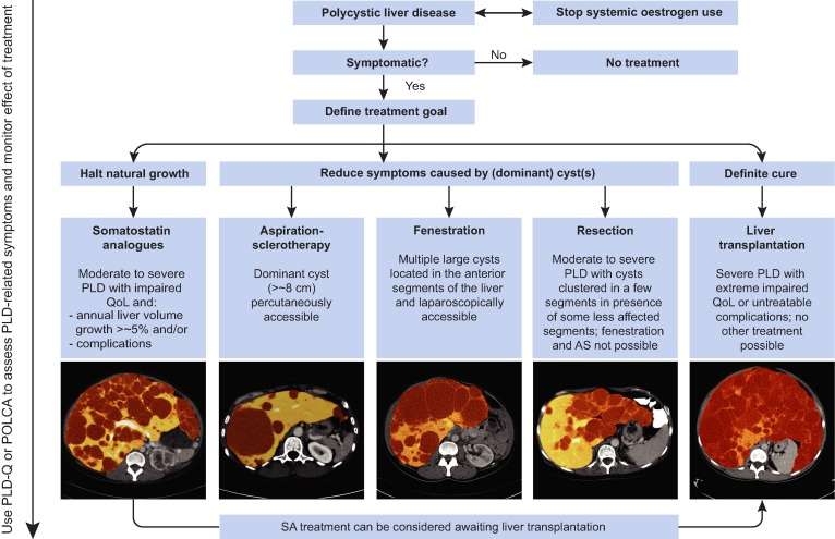 Polycystic liver disease treatment