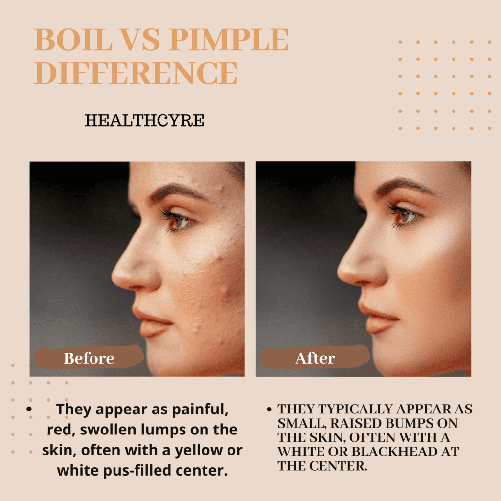 boil vs. pimple