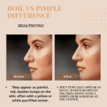 boil vs pimple