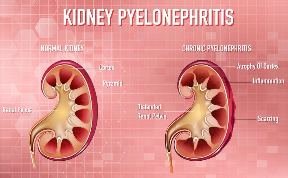 stage 4 kidney cancer